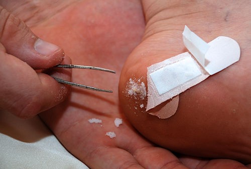 5 Easiest Ways to Remove a Splinter in a Child | Mom and Dad Central